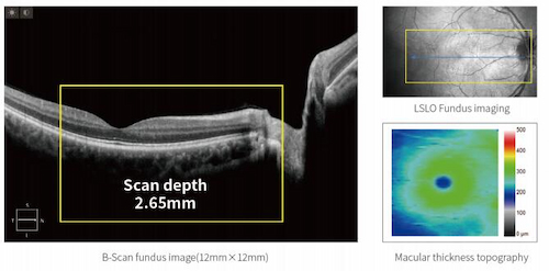 What does optical coherence tomography test for?