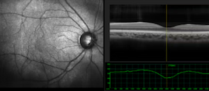Early detection of diabetic retinopathy using OCT imaging