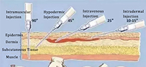 [Nurse Tips] Ten new methods of venipuncture!（3）