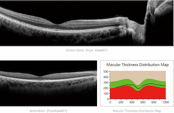 Is optical coherence tomography worth it?