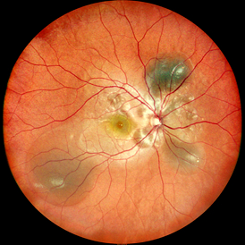 Sudden blurring of vision could be a red alert for a systemic illness