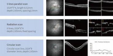 AI + OCT: How can artificial intelligence help ophthalmologists diagnose faster and more accurately?