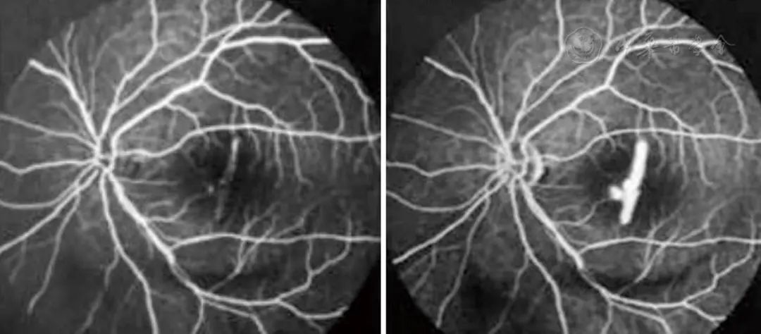 The Role of OCT in Fundus Examination and Treatment