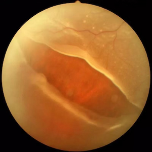 What causes retinal detachment?